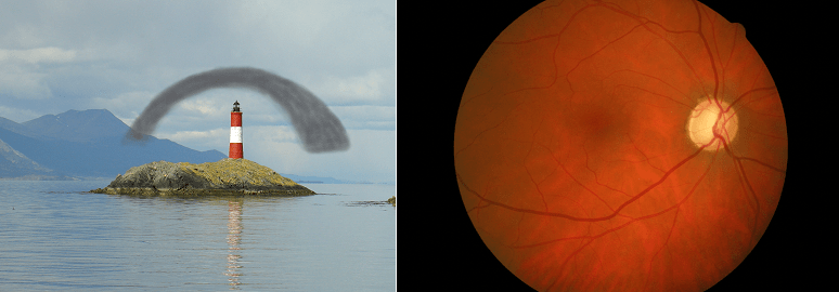 Glaucoma