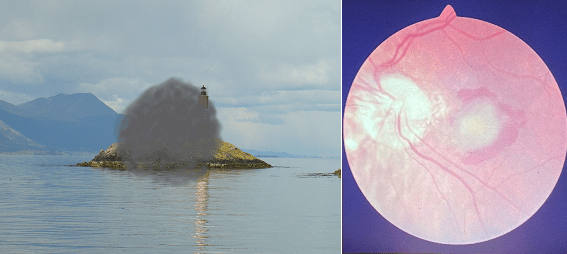 Degeneració macular associada a l'edat