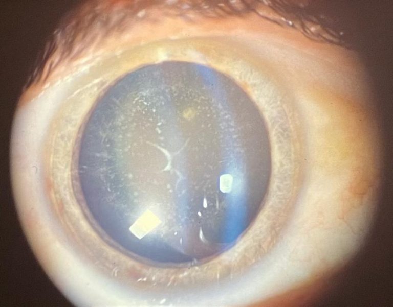 Burgués Oftalmòlegs, el teu oculista a Mataró. Patologies la cataracta